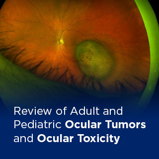 Review of Adult and Pediatric Ocular Tumors and Ocular Toxicity: From Eyelid to Choroid Banner